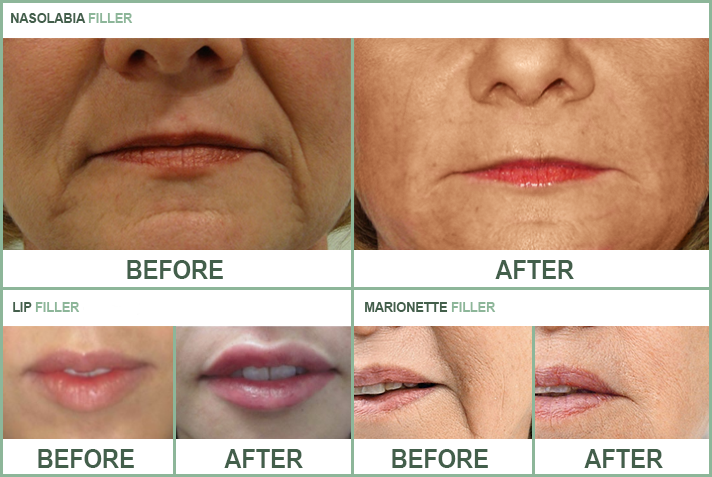 Fillers Before and Afters