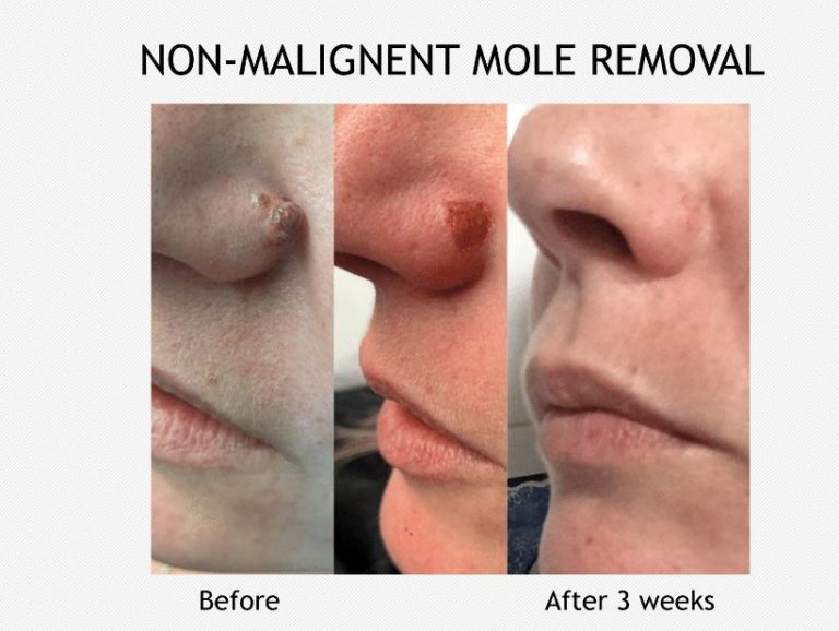 Non-Malignent Mole Remova