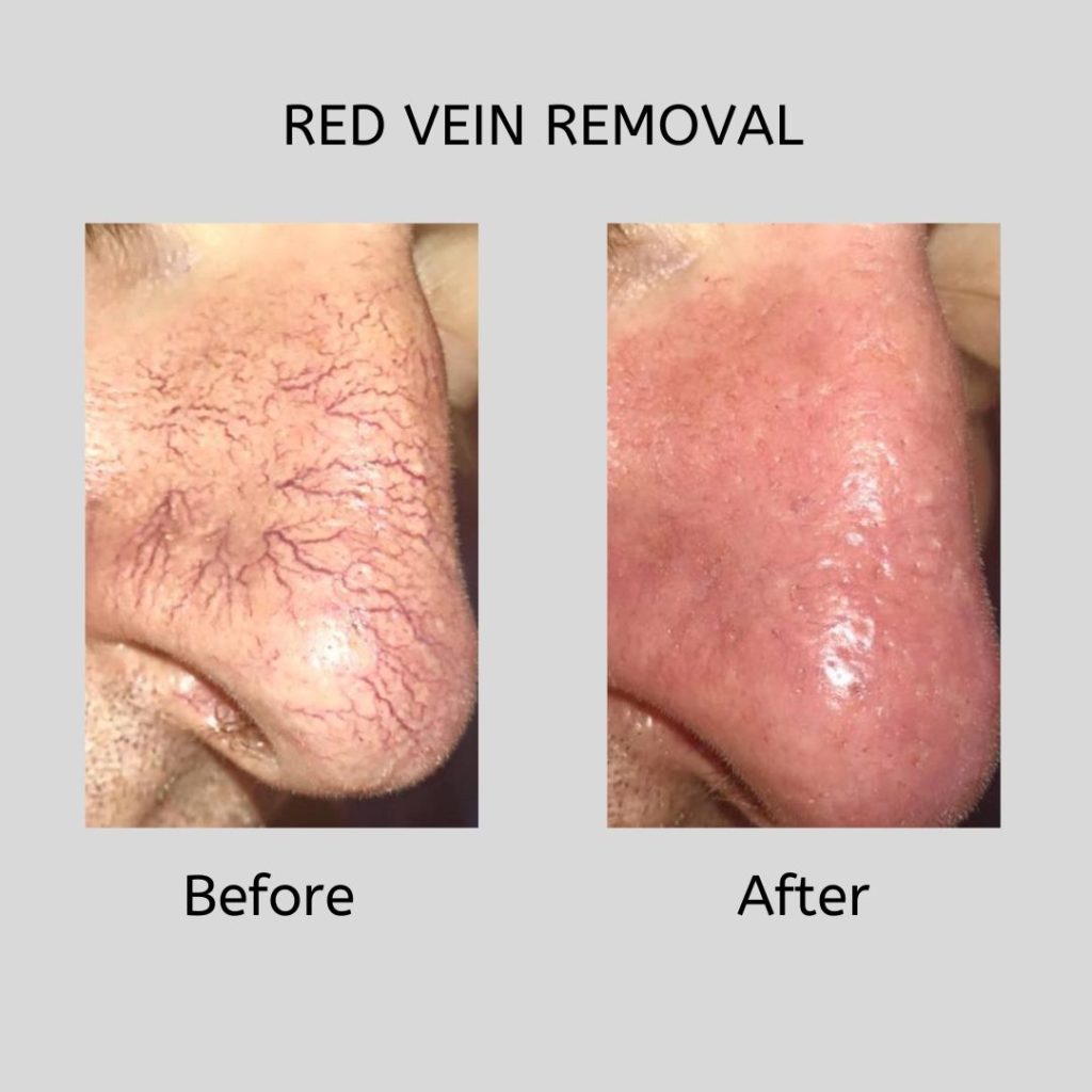 Red Vein Removal Before and After