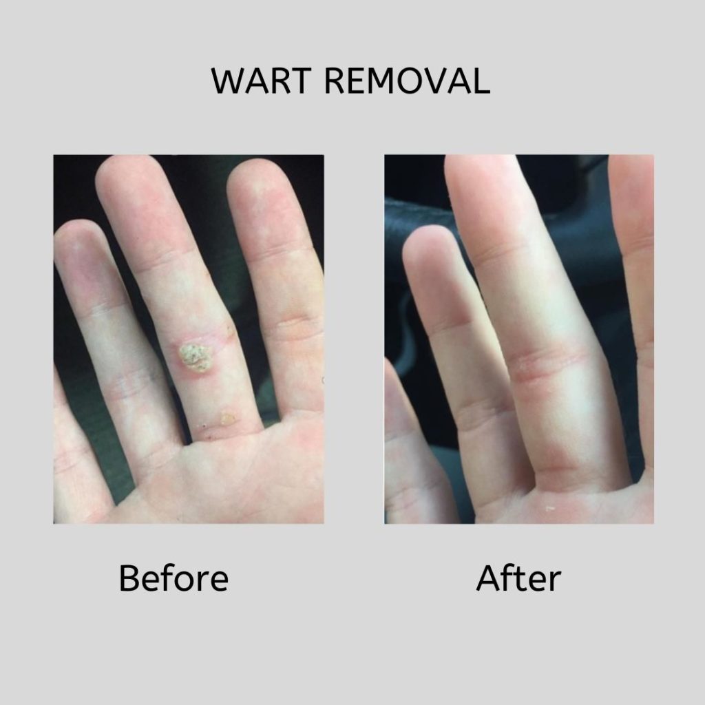 Wart Removal Before and After